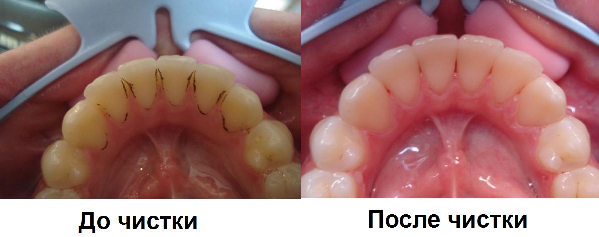 чистка зубов ультразвуком