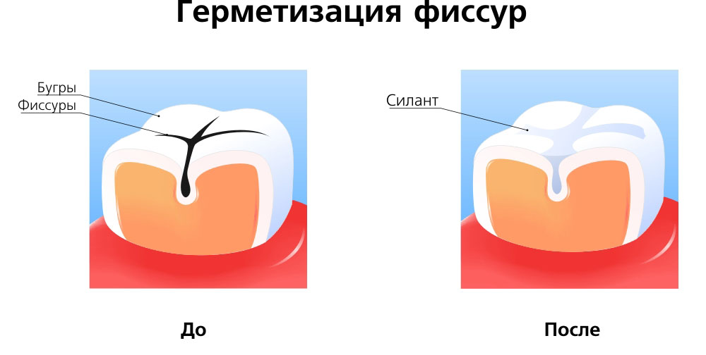 герметизация зубов фиссур