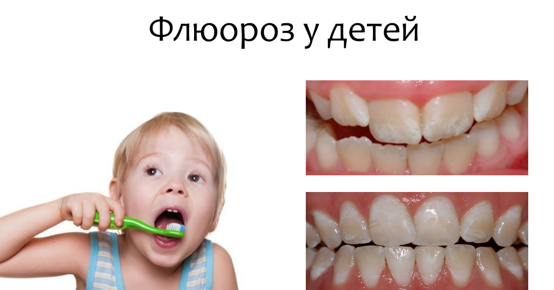 флюороз у детей детская стоматология