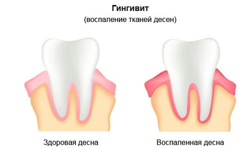 Гингивит