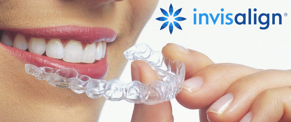 invisalign.jpg