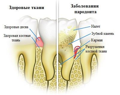 заболевания пародонта