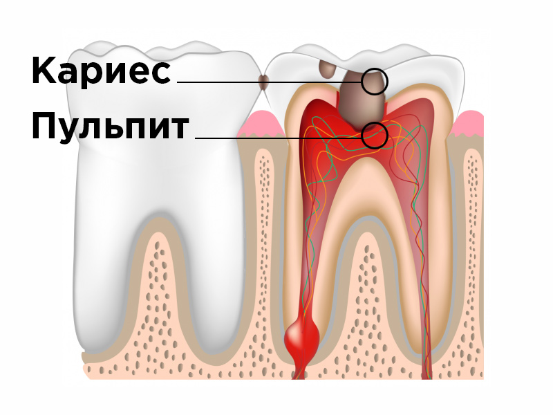 лечение пульпита метро просвещения