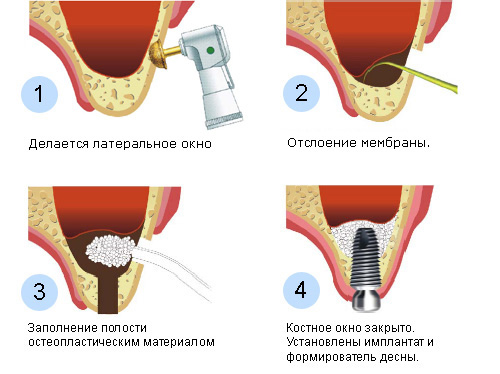 Синуслифтинг