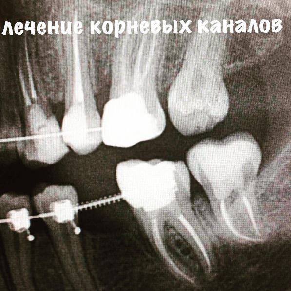 Лечение корневых каналов