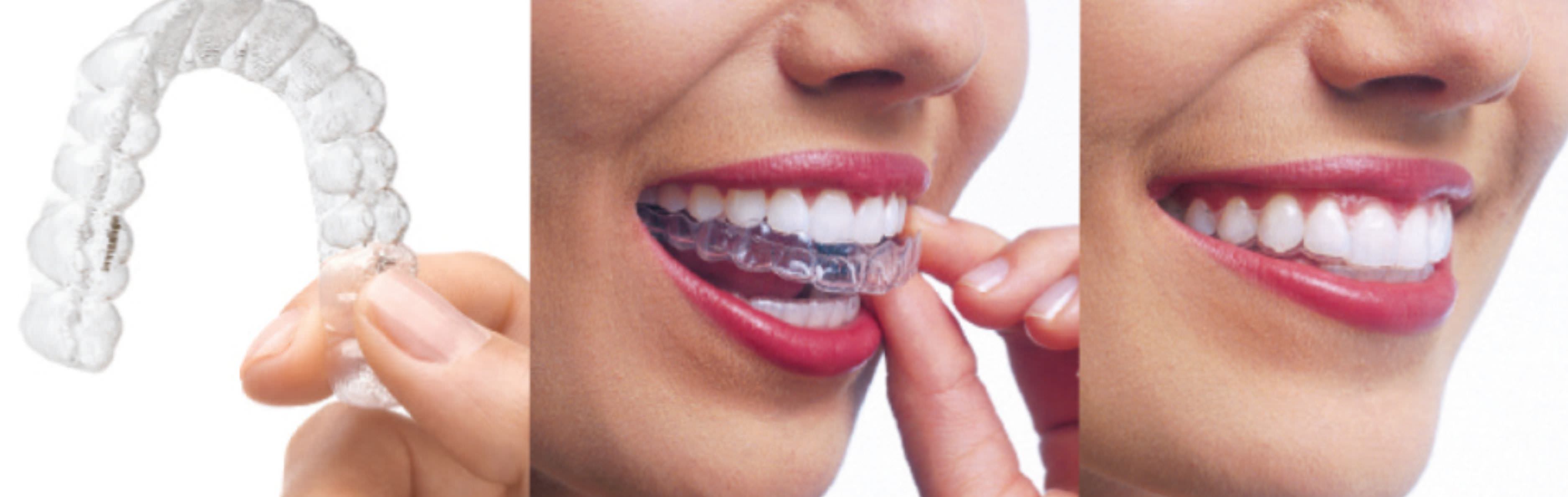 ортодонтия исправление прикуса