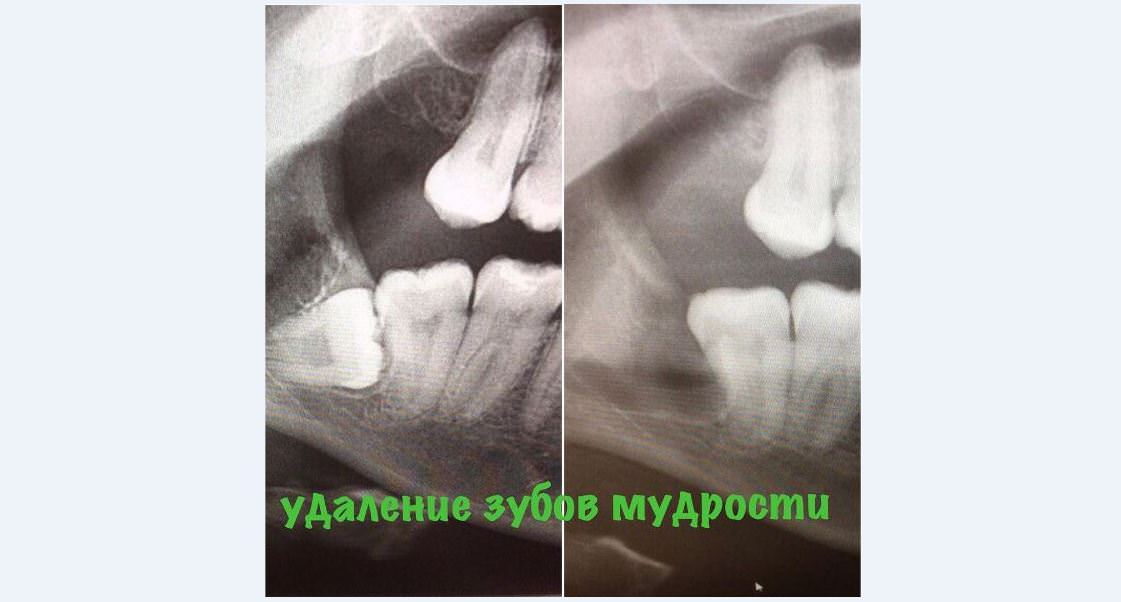 Удаление зубов мудрости